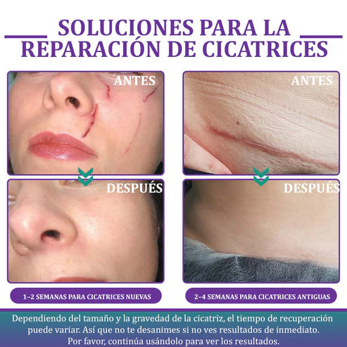 Flysmus® Reducción de cicatrices
